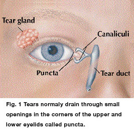 blocked tear duct treatment at Kids Eye Care of Maryland